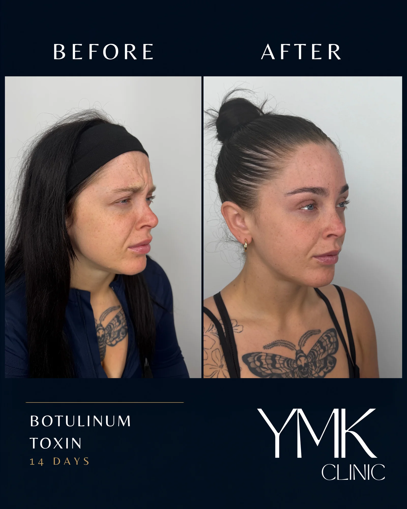 Before and after photographs, case 003.