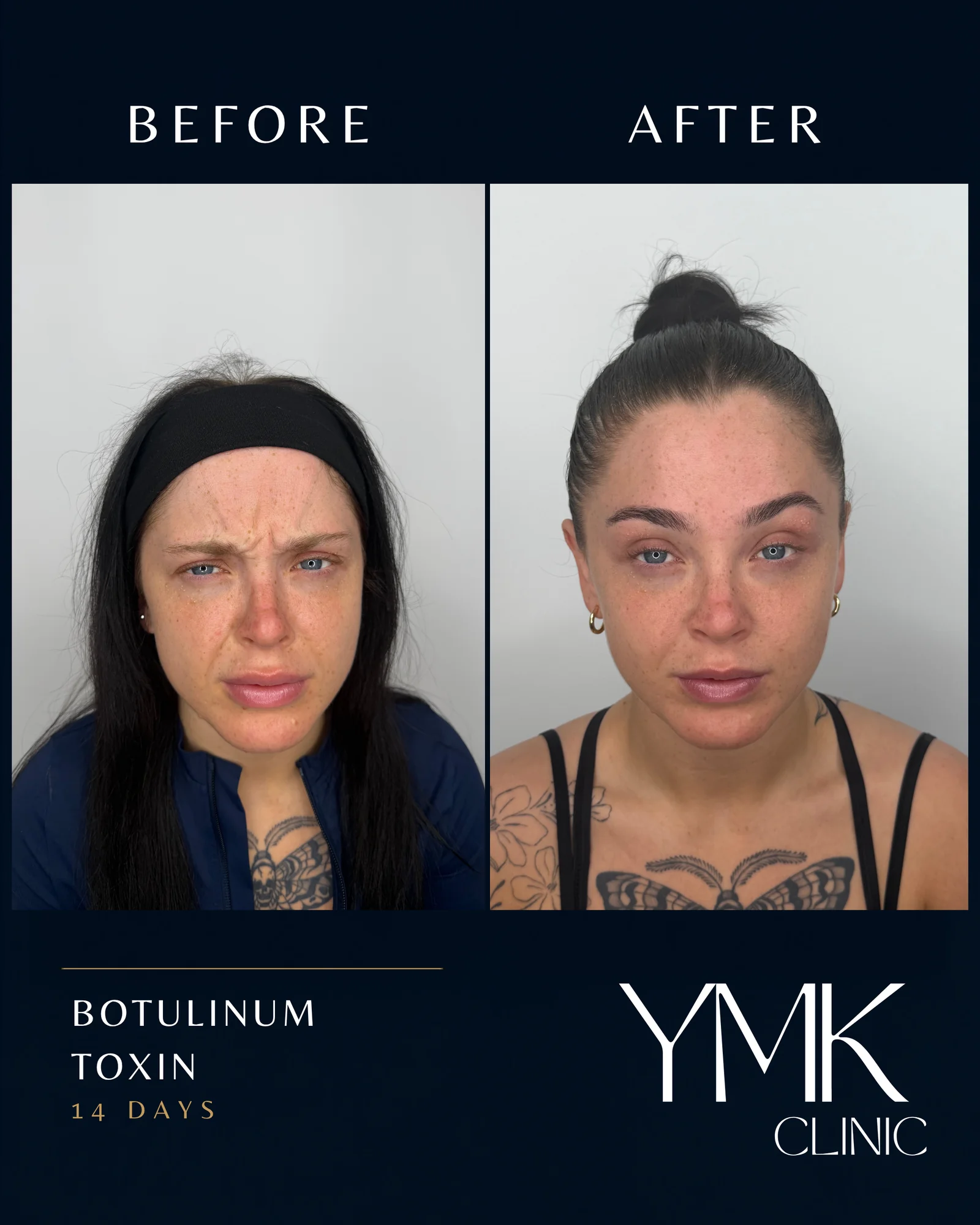 Before and after photographs, case 003.